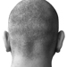 Alopesi